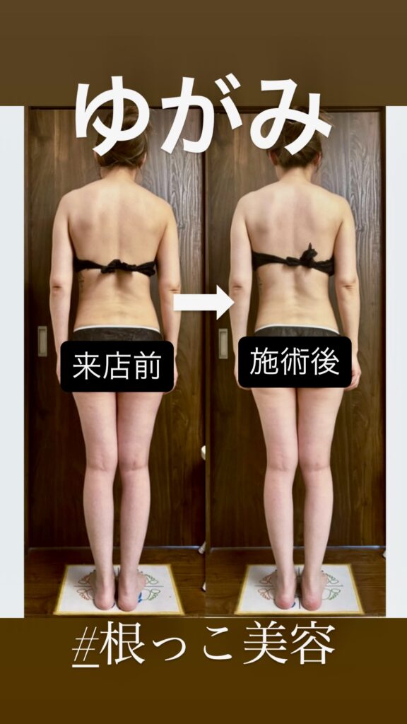 40代女性の背面ビフォーアフター。生体電流施術で体のゆがみと姿勢が整った変化